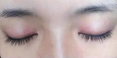 孕睫術(shù)術(shù)后