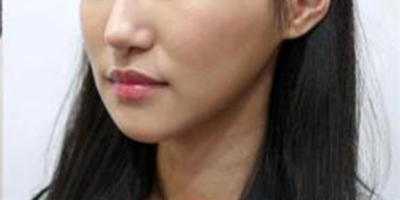 下巴硅膠假體取出術(shù)后