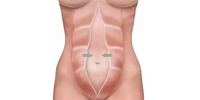 產(chǎn)后塑形術(shù)前