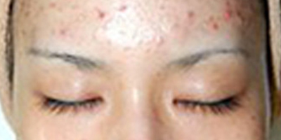 伊膚泉微針術(shù)前