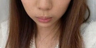 黃金煥膚術(shù)前