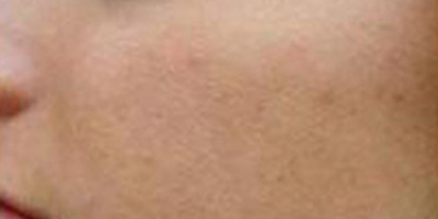 脂肪填充失敗修復術(shù)后