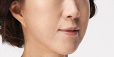 射頻緊膚術(shù)后