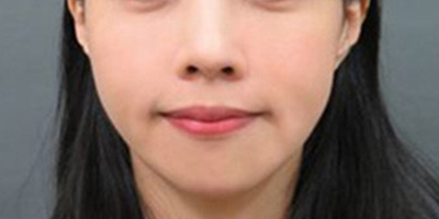 童顏針術(shù)后