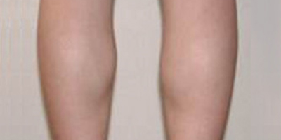 注射瘦小腿術(shù)前