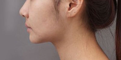 頜面正畸術(shù)后