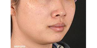 皮秒激光術(shù)前