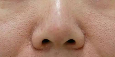 小棕瓶美白術(shù)前