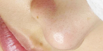 超微小氣泡術(shù)后