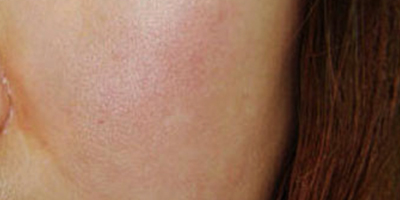 激光祛紅血絲術前