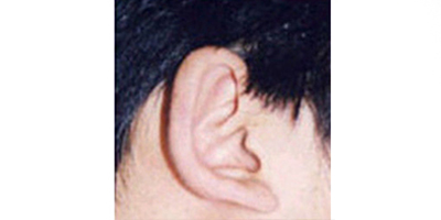 杯狀耳矯正術(shù)前