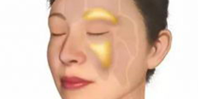 自體脂肪存儲術(shù)后