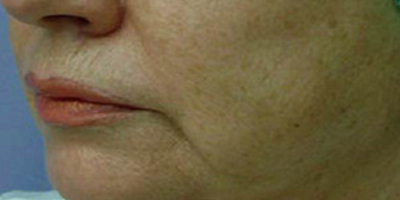 熱拉提術(shù)后