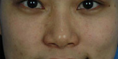 E光嫩膚術(shù)前