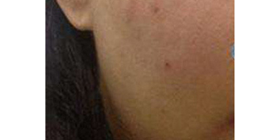 無(wú)針?biāo)庑g(shù)前