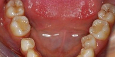 牙周護理術(shù)后