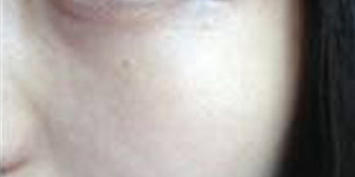 玻尿酸導入術后