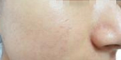 水楊酸煥膚術(shù)后