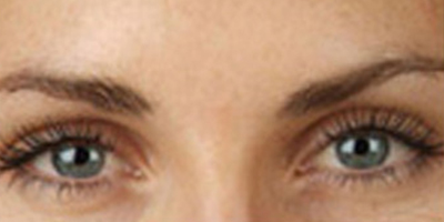 注射去川字紋術后