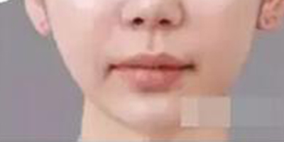 彩光嫩膚術(shù)后