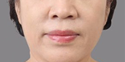 PRP美塑美膚術(shù)后