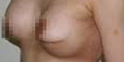 隆胸修復術(shù)前