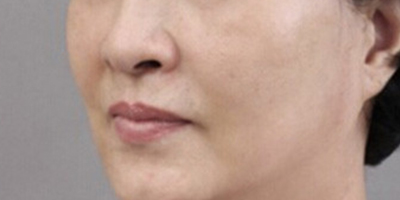 青春解碼儀美膚術后