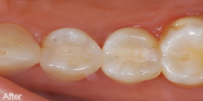 口腔檢查術(shù)后