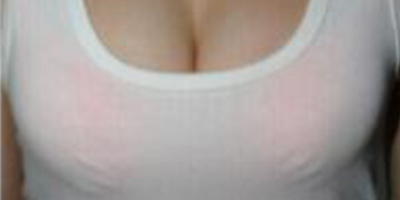 胸部假體取出術(shù)前