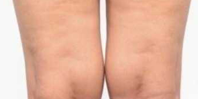 吸脂失敗修復(fù)術(shù)前