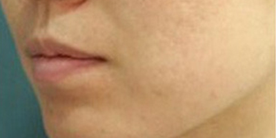 海菲秀皮膚護理術(shù)后