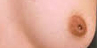 乳頭內(nèi)陷矯正術(shù)前