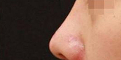 注射物取出術(shù)后