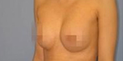 自體脂肪隆胸術(shù)后