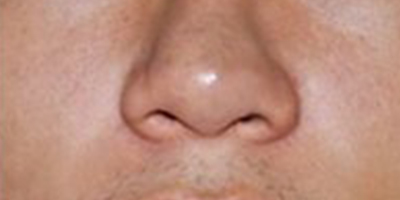 激光去胎記術(shù)后