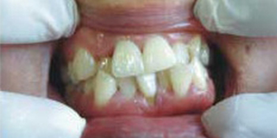 貴金屬烤瓷牙術(shù)前