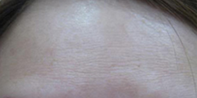 注射去抬頭紋術(shù)后