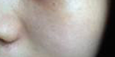 玻尿酸導入術前