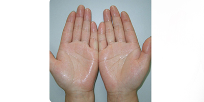 注射治療多汗術(shù)前