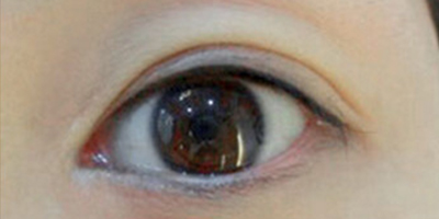 半永久美瞳線術(shù)后