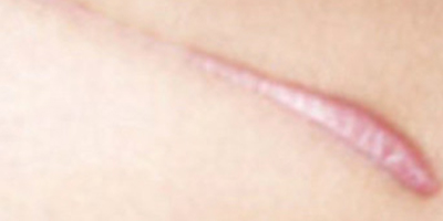 無創(chuàng)疤痕修復(fù)術(shù)前