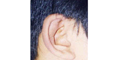 杯狀耳矯正術(shù)后
