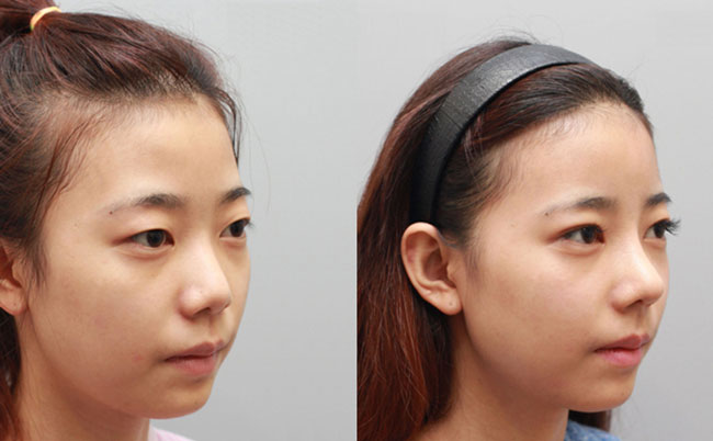 耳軟骨隆鼻的優(yōu)缺點(diǎn)是什么？肋軟骨隆鼻和耳軟骨隆鼻有什么區(qū)別？