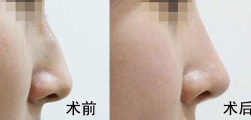 駝峰鼻矯正的方法有哪些？駝峰鼻矯正的方式及適合人群？