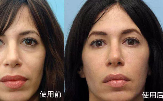 法令紋去除手術(shù)效果好嗎？法令紋怎么消除?最好的方法是什么？