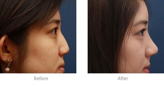 隆鼻假體取出后鼻子會(huì)不會(huì)變形？隆鼻假體取出后能不能恢復(fù)原樣？