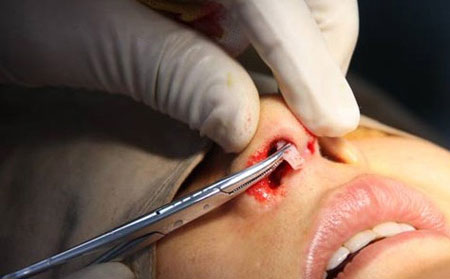 鼻子假體取出需要多少錢？取出后鼻子會(huì)恢復(fù)原來樣子嗎？