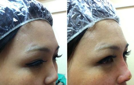 埋線手術(shù)鼻子的效果能保持多久?埋線手術(shù)隆鼻術(shù)后注意事項是什么?