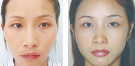 假體填充豐太陽穴怎么做？假體豐太陽穴的方法有哪些？