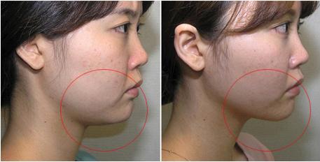 雙下巴吸脂多長時間恢復？雙下巴吸脂術能保持多久？